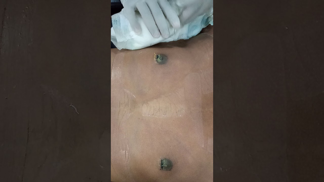 Man Boobs Surgery Dressing removals after 2 days in Bangalore  @DezireClinic