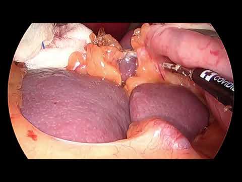 Laparoscopic Sleeve gastrectomy in situs inversus